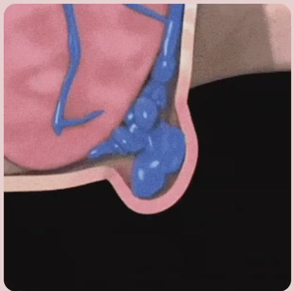 Helevix örtkräm mot hemorrojder | Behandlar 99 % av hemorrojderna redan efter första appliceringen!